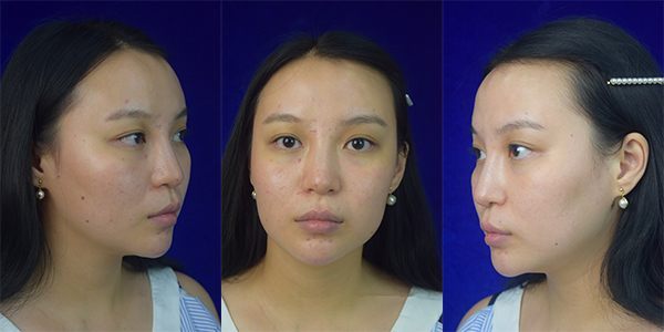 太原時(shí)光整形醫(yī)院案例