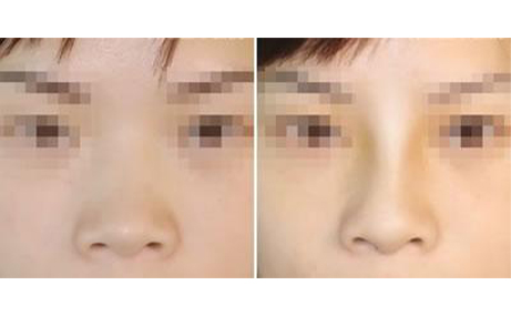 做隆鼻手術(shù)會留疤嗎？