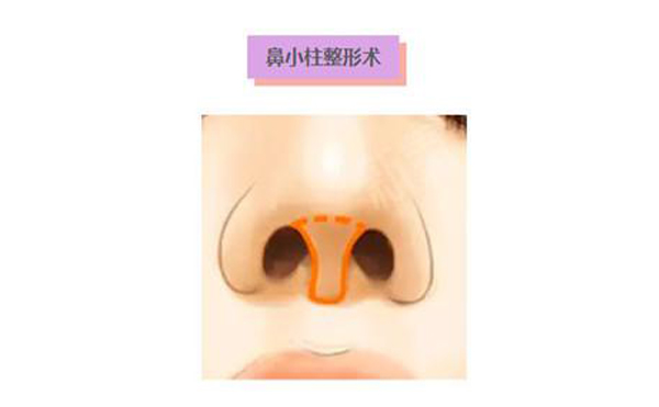 鼻小柱延長(zhǎng)術(shù)是什么？鼻小柱延長(zhǎng)手術(shù)有什么優(yōu)點(diǎn)