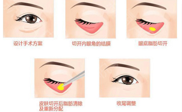 做去眼袋的手術(shù)會(huì)不會(huì)反彈?有副作用嗎?