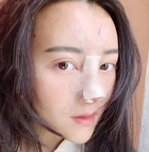 金輝醫(yī)生鼻修復案例：