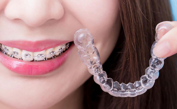 隱形牙套價(jià)格多少錢(qián)？