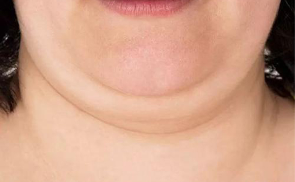 人為什么會(huì)有雙下巴