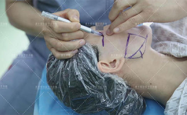 醫(yī)院醫(yī)生做改臉型手術應遵循什么原則?術前檢查有哪些?