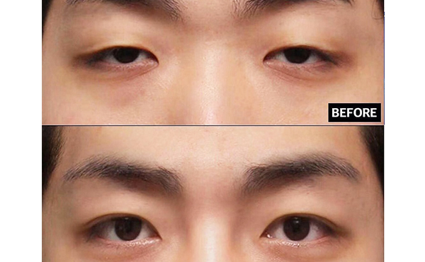 上瞼下垂是什么原因造成的?上瞼下垂怎么改善?