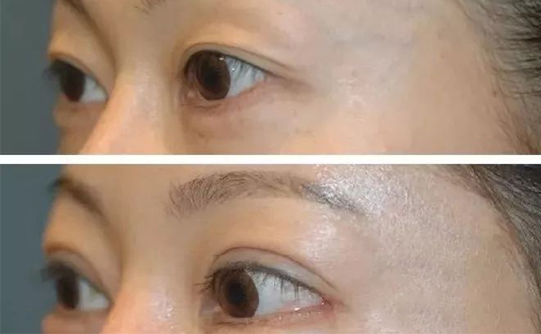 開外眼角需要多久恢復(fù)？