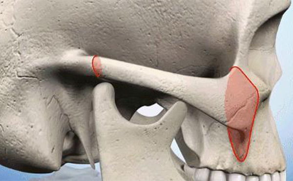 顴骨內推和磨顴骨的區(qū)別是什么?