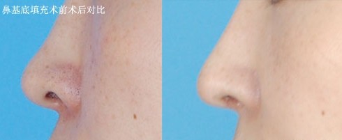 南京美貝爾做鼻基底效果術前術后對比