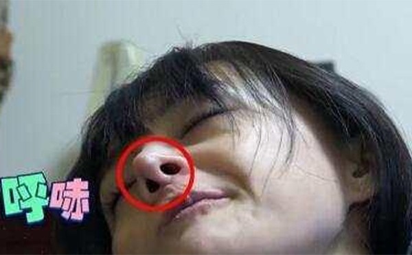 鼻假體取出后會(huì)變形嗎?能恢復(fù)原樣嗎?