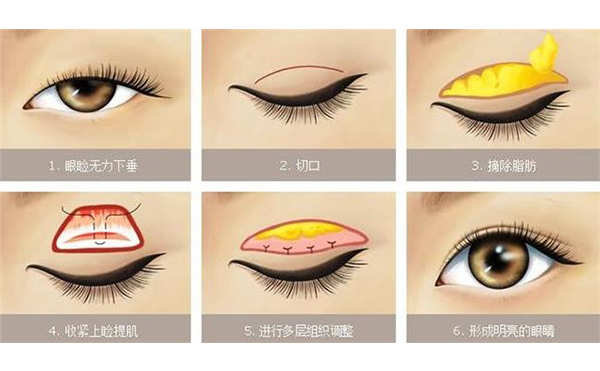 上瞼下垂價(jià)格多少?上瞼下垂術(shù)后有哪些問(wèn)題?