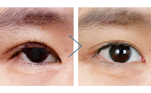眼瞼外翻是什么導(dǎo)致的?眼瞼外翻怎么修復(fù)?