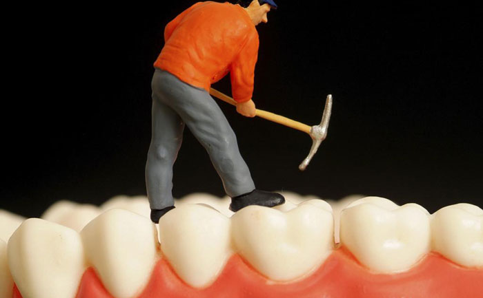 鑲牙要多少錢一顆費用？