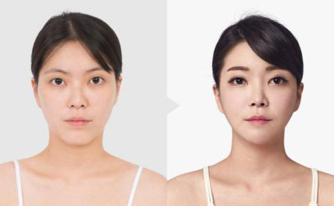 韓式埋線雙眼皮多久恢復(fù)自然？