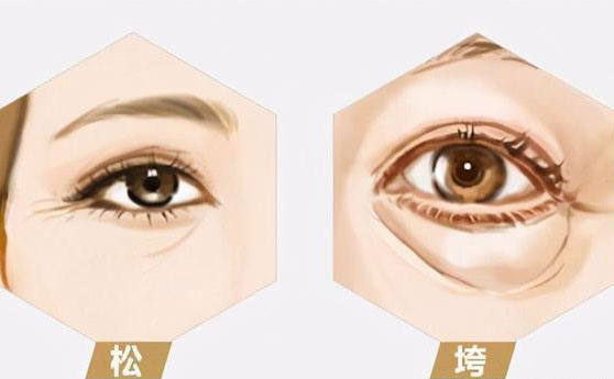 無(wú)痛去眼袋價(jià)格多少錢(qián)？