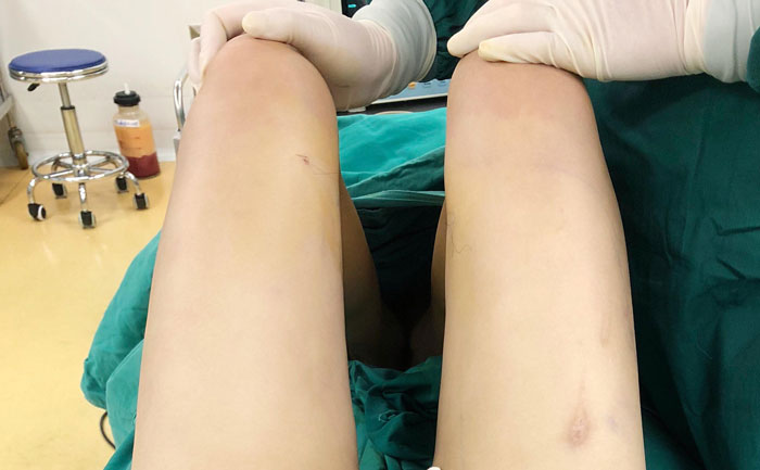 腿部吸脂手術(shù)多少錢？腿部吸脂會不會留下后遺癥？