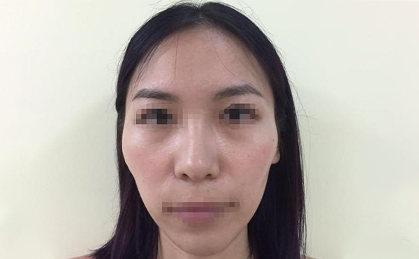 顴骨降低手術(shù)疼不疼？