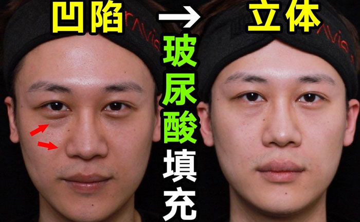 淚溝填充用什么方法最好？淚溝填充手術(shù)大約多少錢？