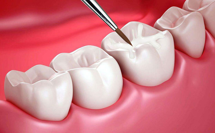 貴金屬烤瓷牙有哪些？貴金屬烤瓷牙的種類