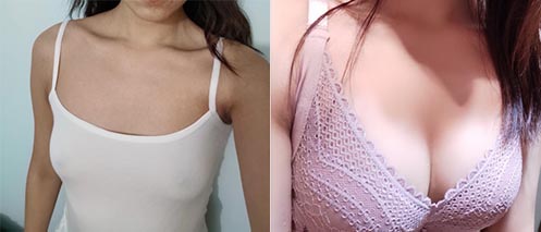 假體隆胸手術效果對比圖3