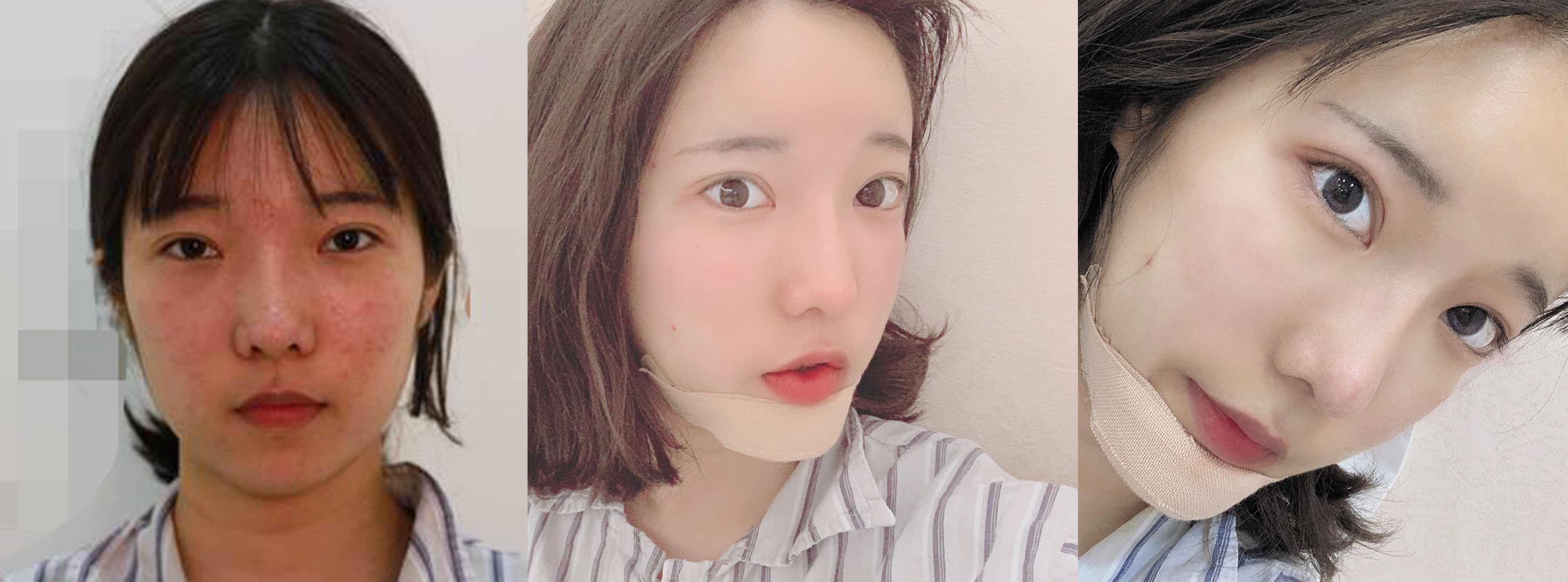 杭州時(shí)光自體脂肪填充效果圖1