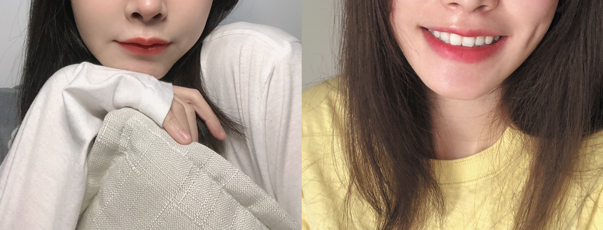 金窩銀窩不如小酒窩~酒窩再造術，甜美少女斬男神器！