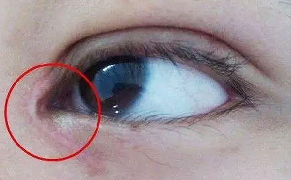 內(nèi)眼角修復(fù)難不難？哪些情況需要修復(fù)?