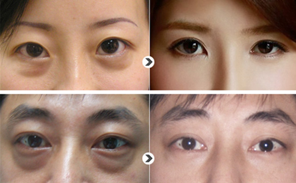眼袋抽脂效果好嗎?眼袋抽脂有哪些注意事項(xiàng)?