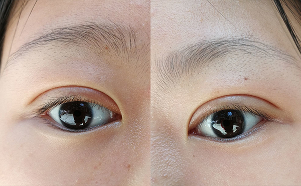 雙眼皮術(shù)后有肉條怎么辦?什么時(shí)候修復(fù)效果好?