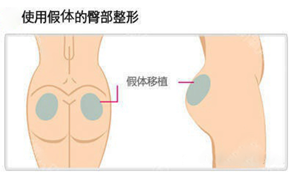 假體豐臀多少錢？假體豐臀效果是永久的嗎？