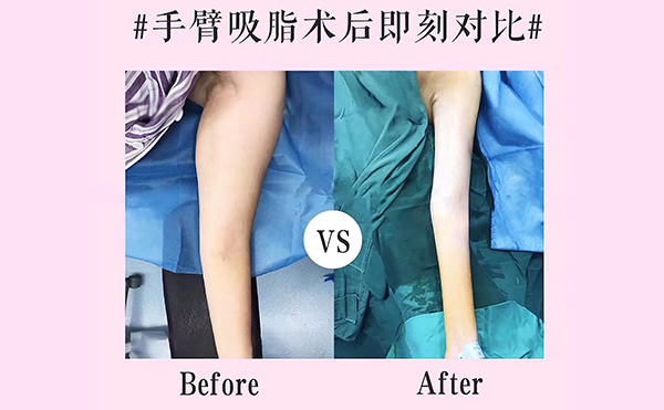 手臂吸脂會反彈嗎？