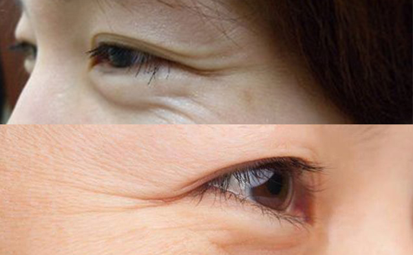 魚尾紋有哪幾種類型？