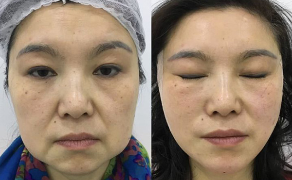 超聲刀適合哪些人群？