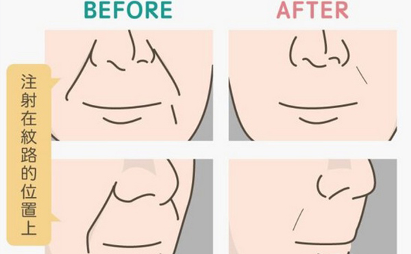 玻尿酸填充法令紋一般需要幾支?能維持多久?