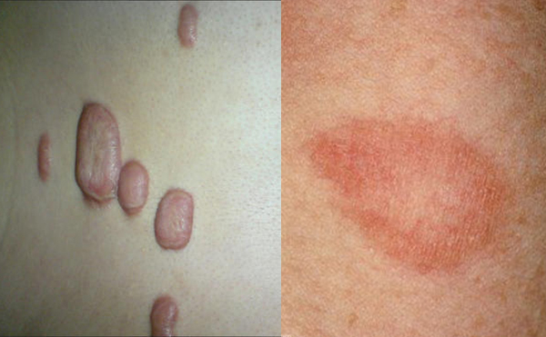 激光去頸紋有并發(fā)癥嗎？