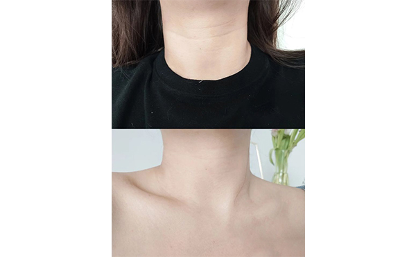 超聲刀去頸紋一年可以做幾次？