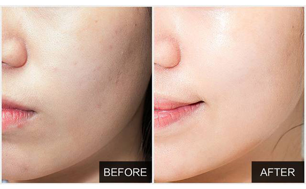 水光針能維持多久？