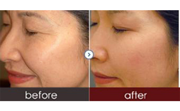 水光針有副作用嗎？