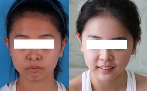 激光美白有什么優(yōu)缺點？