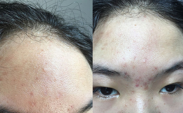 哪些人不適合做冰點(diǎn)面部脫毛？