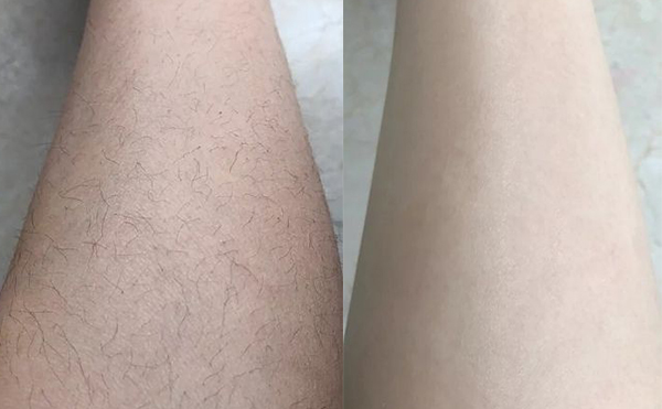 冰點(diǎn)脫腿毛效果怎么樣？