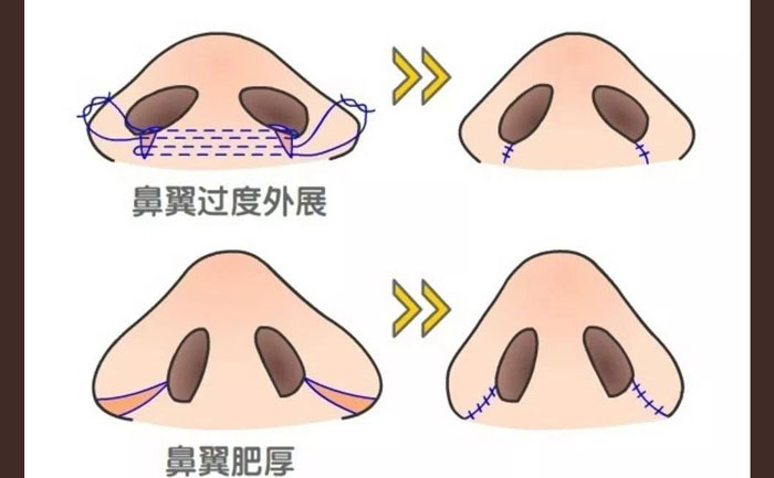 鼻頭肥大怎么改善？鼻頭肥大矯正術(shù)多少錢？