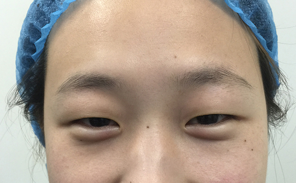 腫眼泡是怎么回事?腫眼泡適合做什么樣的雙眼皮?