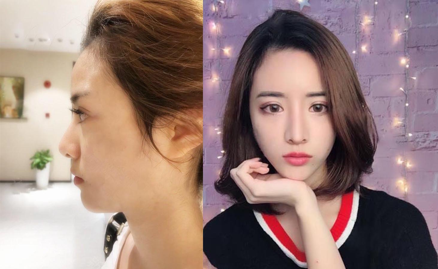 洛陽醫(yī)生隆鼻效果