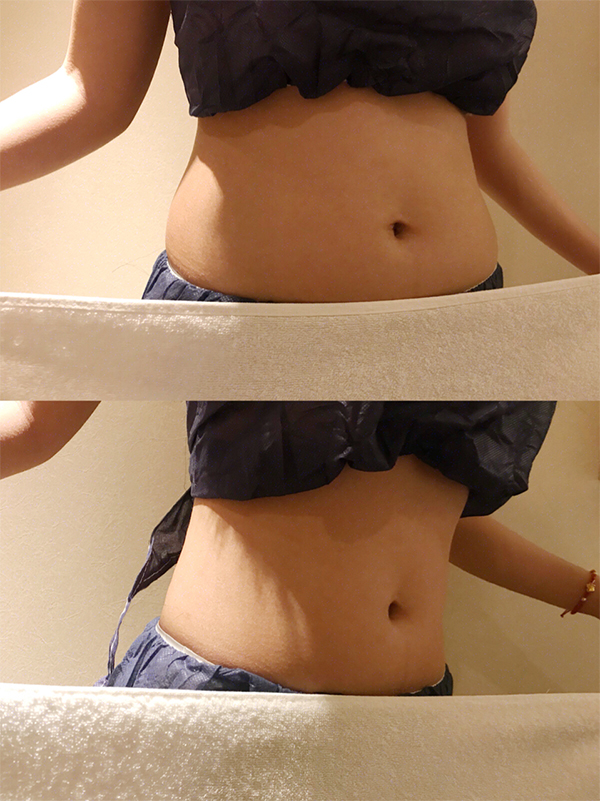 腰腹環(huán)吸術(shù)效果對比圖2
