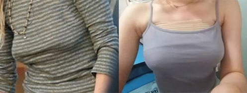 產(chǎn)后胸部下垂手術(shù)前后對(duì)比