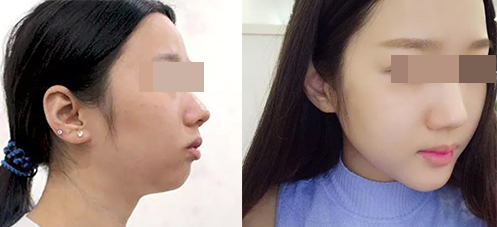 北京潤美玉之光醫(yī)療美容墊下巴