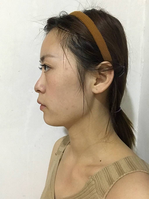 天津伊美爾超肋鼻綜合案例大賞