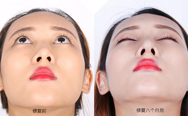 隆鼻手術(shù)失敗怎么辦？修復(fù)費(fèi)用要多少？
