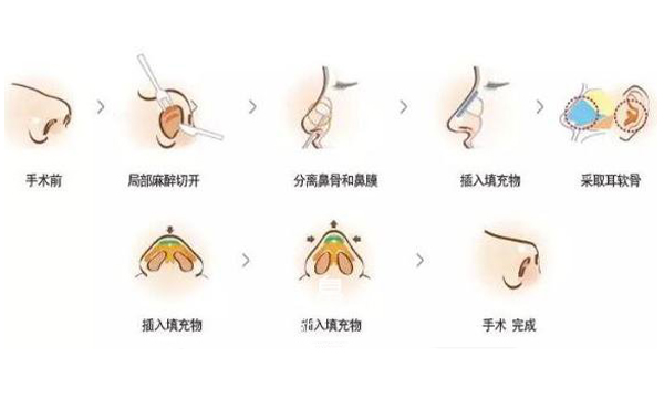 耳軟骨隆鼻效果怎么樣？要多少錢？