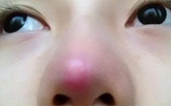 術(shù)后鼻頭發(fā)紅是隆鼻手術(shù)失敗了嗎？該怎么處理？